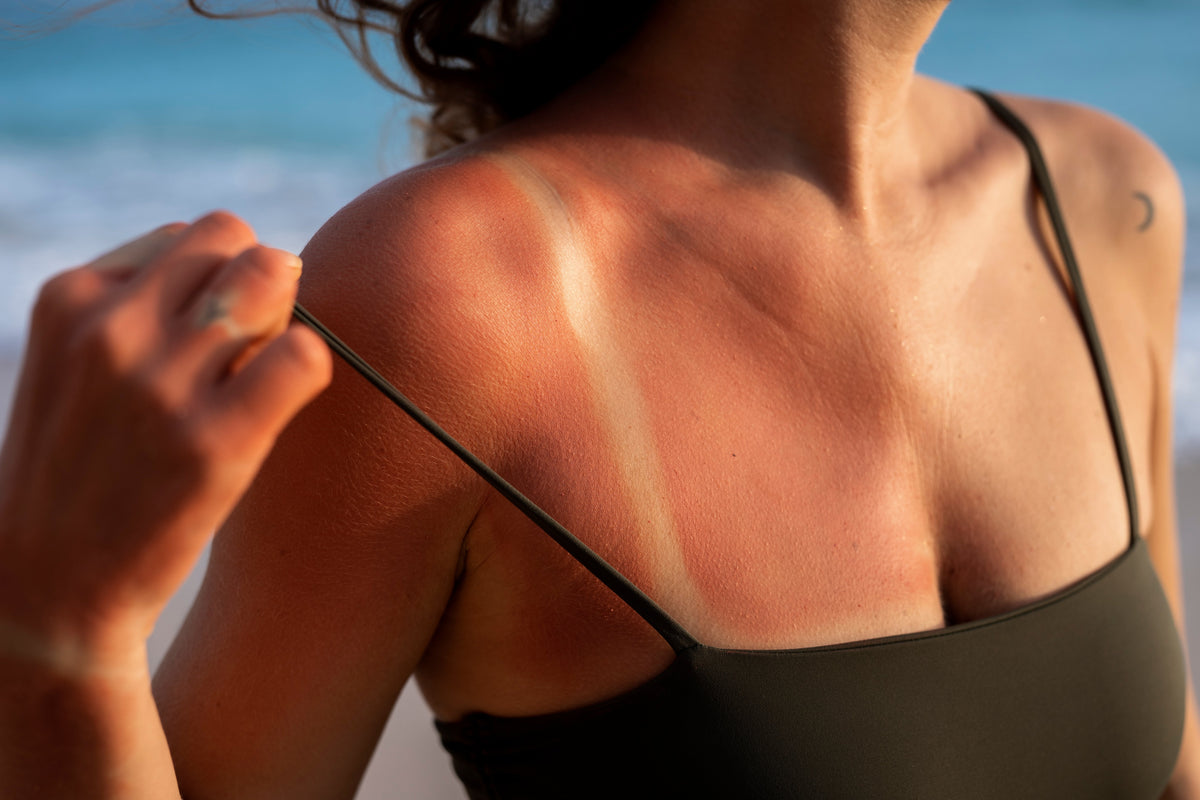 Pós-sol: como recuperar a pele depois de um dia de praia